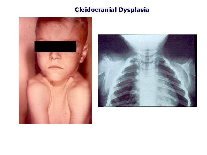 Cleidocranial Dysplasia 