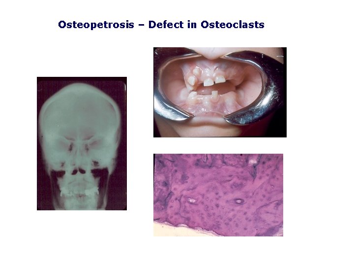 Osteopetrosis – Defect in Osteoclasts 