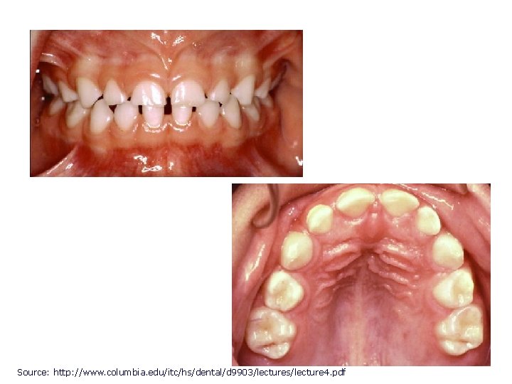 Source: http: //www. columbia. edu/itc/hs/dental/d 9903/lectures/lecture 4. pdf 