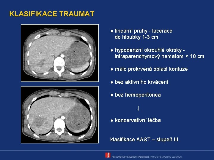 KLASIFIKACE TRAUMAT ● lineární pruhy - lacerace do hloubky 1 -3 cm ● hypodenzní