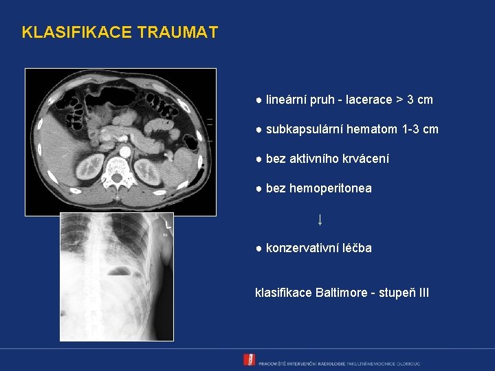 KLASIFIKACE TRAUMAT ● lineární pruh - lacerace > 3 cm ● subkapsulární hematom 1