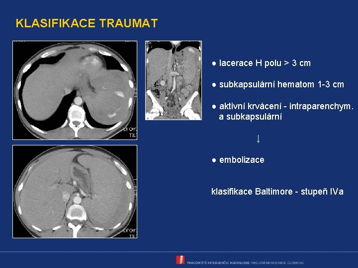 KLASIFIKACE TRAUMAT ● lacerace H polu > 3 cm ● subkapsulární hematom 1 -3