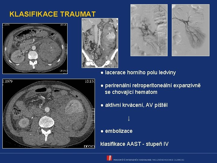 KLASIFIKACE TRAUMAT ● lacerace horního polu ledviny ● perirenální retroperitoneální expanzivně se chovající hematom