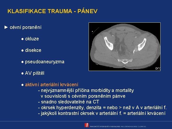 KLASIFIKACE TRAUMA - PÁNEV ► cévní poranění ● okluze ● disekce ● pseudoaneuryzma ●