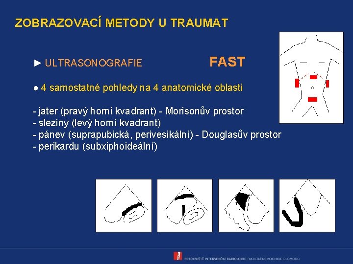 ZOBRAZOVACÍ METODY U TRAUMAT ► ULTRASONOGRAFIE FAST ● 4 samostatné pohledy na 4 anatomické