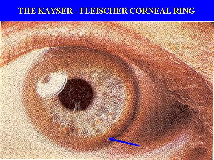 THE KAYSER - FLEISCHER CORNEAL RING 
