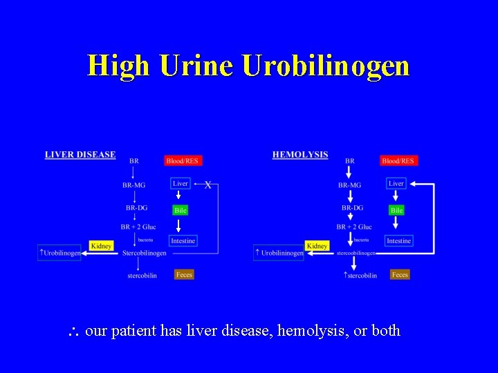 High Urine Urobilinogen our patient has liver disease, hemolysis, or both 