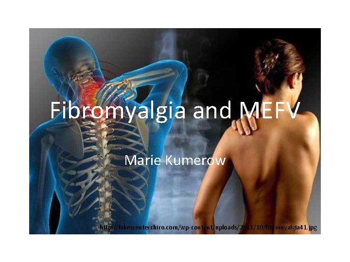 Fibromyalgia and MEFV Marie Kumerow http: //lakescenterchiro. com/wp-content/uploads/2011/10/fibromyalgia 41. jpg 