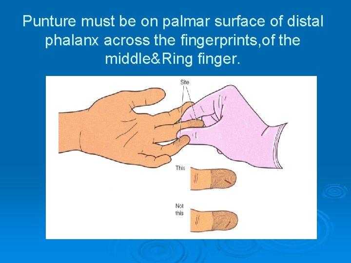 Punture must be on palmar surface of distal phalanx across the fingerprints, of the