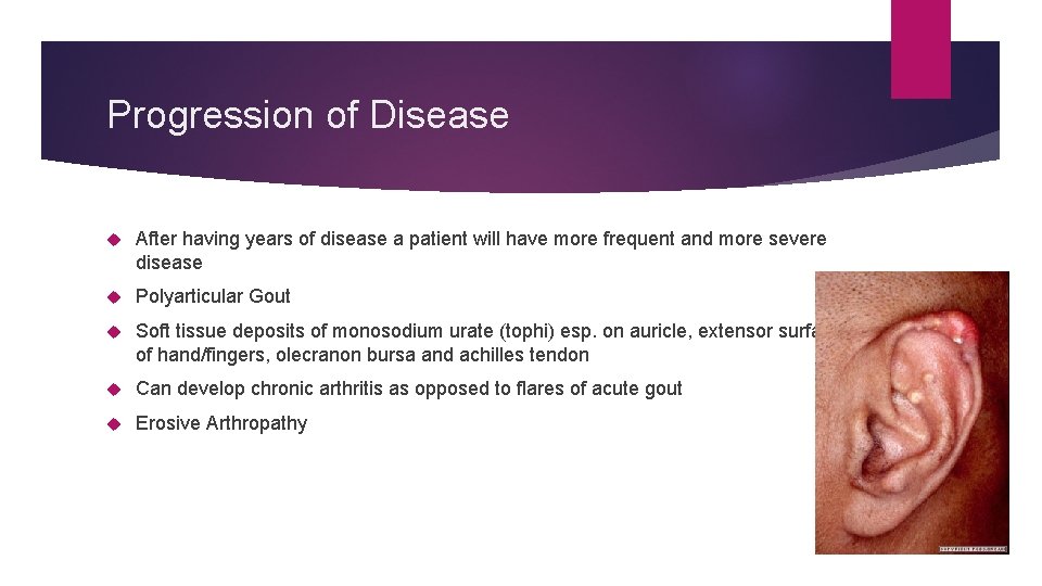 Progression of Disease After having years of disease a patient will have more frequent