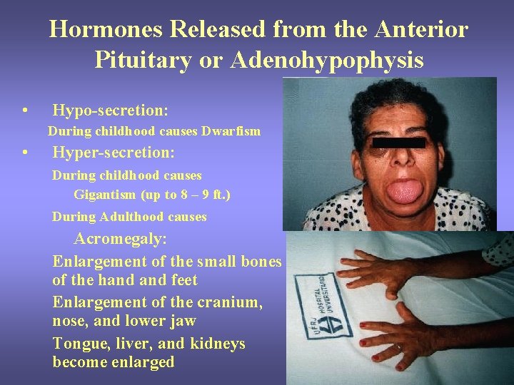 Hormones Released from the Anterior Pituitary or Adenohypophysis • Hypo-secretion: During childhood causes Dwarfism Hormones Released from the Anterior Pituitary or Adenohypophysis • Hypo-secretion: During childhood causes Dwarfism