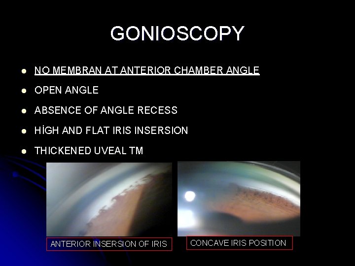 GONIOSCOPY l NO MEMBRAN AT ANTERIOR CHAMBER ANGLE l OPEN ANGLE l ABSENCE OF