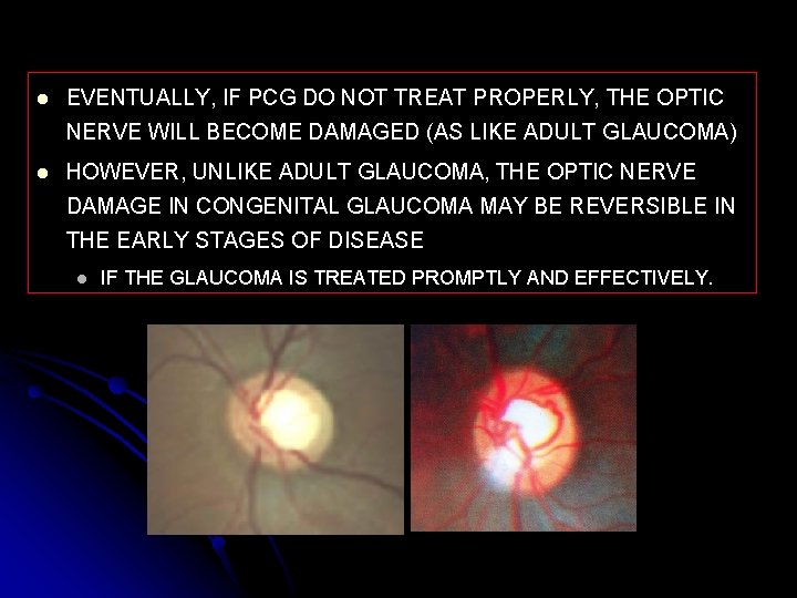 l EVENTUALLY, IF PCG DO NOT TREAT PROPERLY, THE OPTIC NERVE WILL BECOME DAMAGED
