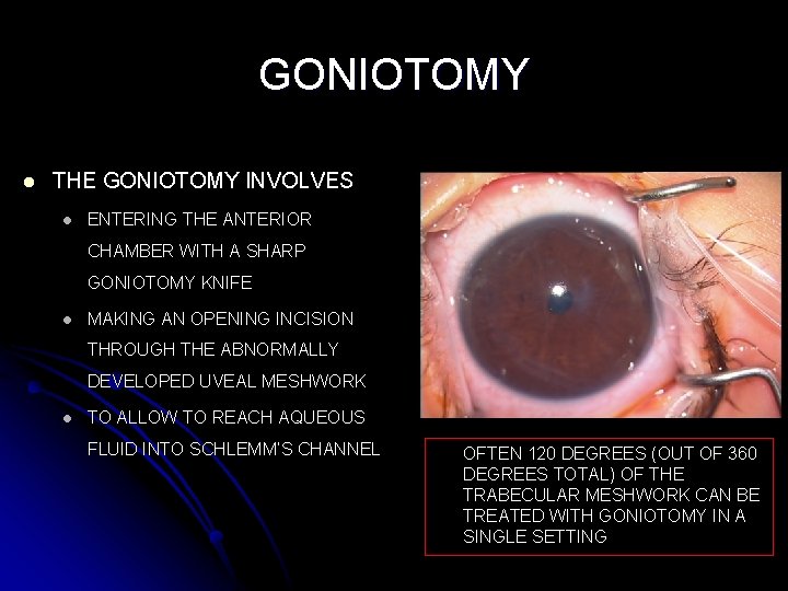 GONIOTOMY l THE GONIOTOMY INVOLVES l ENTERING THE ANTERIOR CHAMBER WITH A SHARP GONIOTOMY