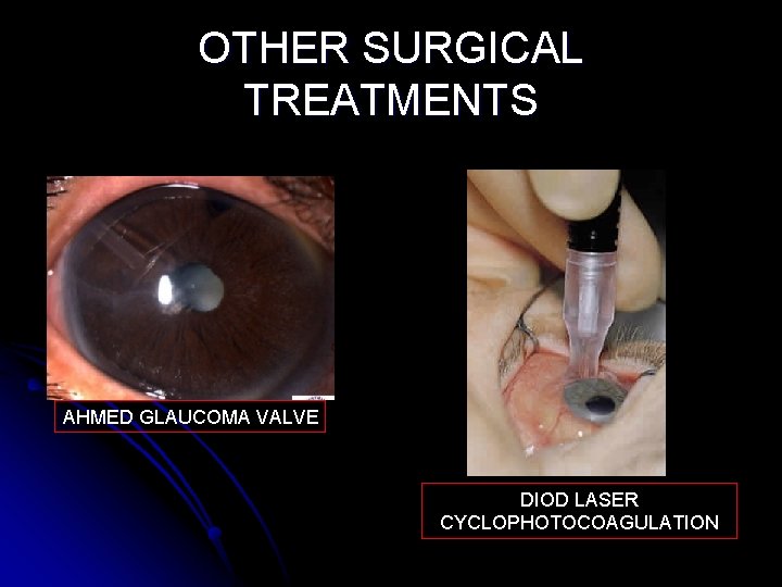 OTHER SURGICAL TREATMENTS AHMED GLAUCOMA VALVE DIOD LASER CYCLOPHOTOCOAGULATION 