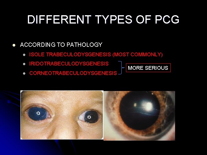 DIFFERENT TYPES OF PCG l ACCORDING TO PATHOLOGY l ISOLE TRABECULODYSGENESIS (MOST COMMONLY) l