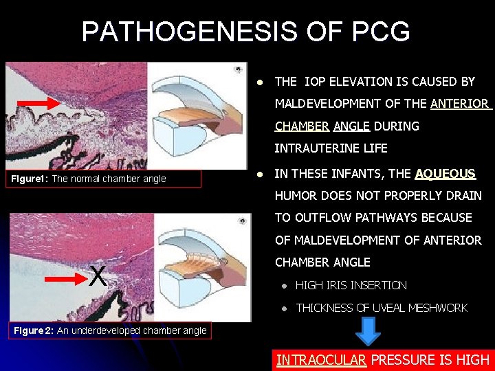 PATHOGENESIS OF PCG l THE IOP ELEVATION IS CAUSED BY MALDEVELOPMENT OF THE ANTERIOR