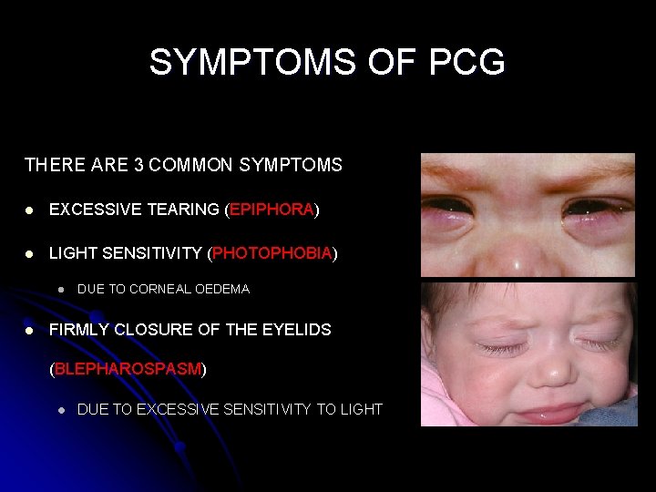 SYMPTOMS OF PCG THERE ARE 3 COMMON SYMPTOMS l EXCESSIVE TEARING (EPIPHORA) l LIGHT