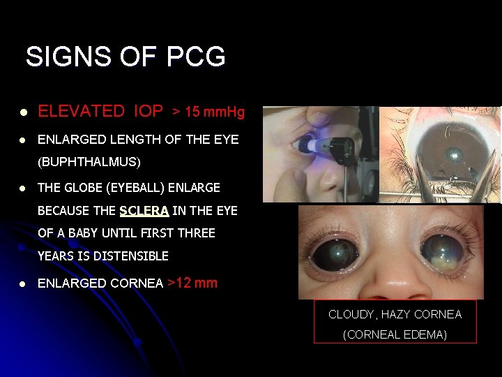 SIGNS OF PCG l ELEVATED IOP > 15 mm. Hg l ENLARGED LENGTH OF