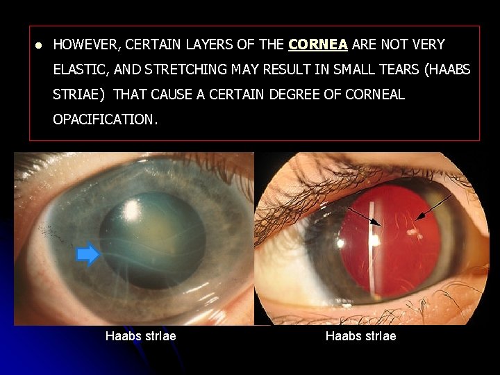 l HOWEVER, CERTAIN LAYERS OF THE CORNEA ARE NOT VERY ELASTIC, AND STRETCHING MAY