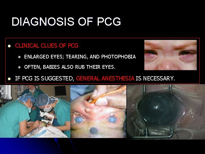 DIAGNOSIS OF PCG l l CLINICAL CLUES OF PCG l ENLARGED EYES; TEARING, AND