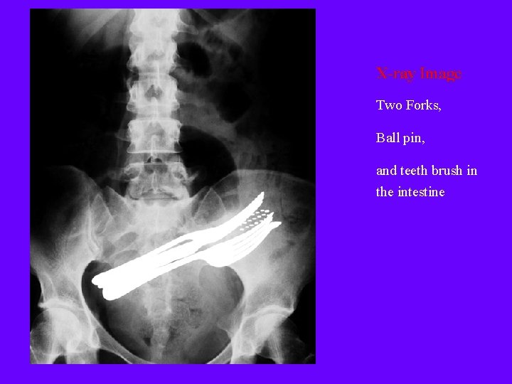 X-ray Image Two Forks, Ball pin, and teeth brush in the intestine 