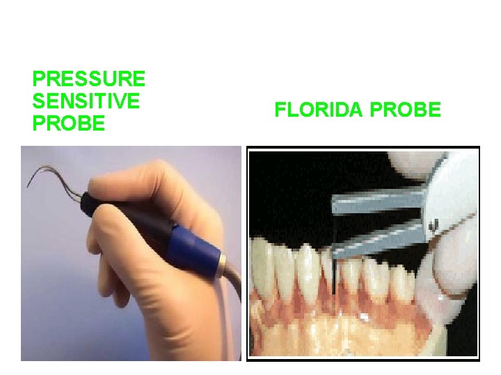 PRESSURE SENSITIVE PROBE FLORIDA PROBE PRESSURE SENSITIVE PROBE FLORIDA PROBE