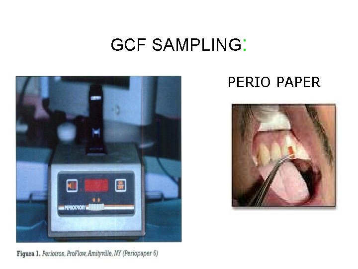 GCF SAMPLING: PERIO PAPER GCF SAMPLING: PERIO PAPER