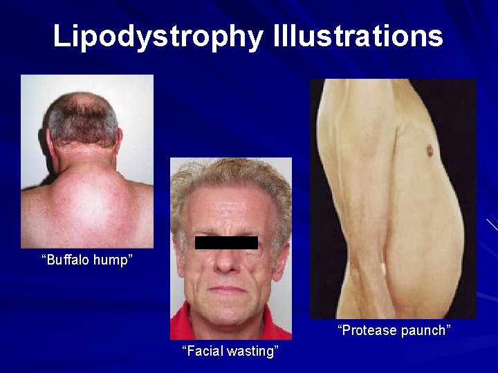 Lipodystrophy Illustrations “Buffalo hump” “Protease paunch” “Facial wasting” 