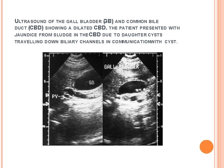 ULTRASOUND OF THE GALL BLADDER G ( B) AND COMMON BILE DUCT (CBD) SHOWING