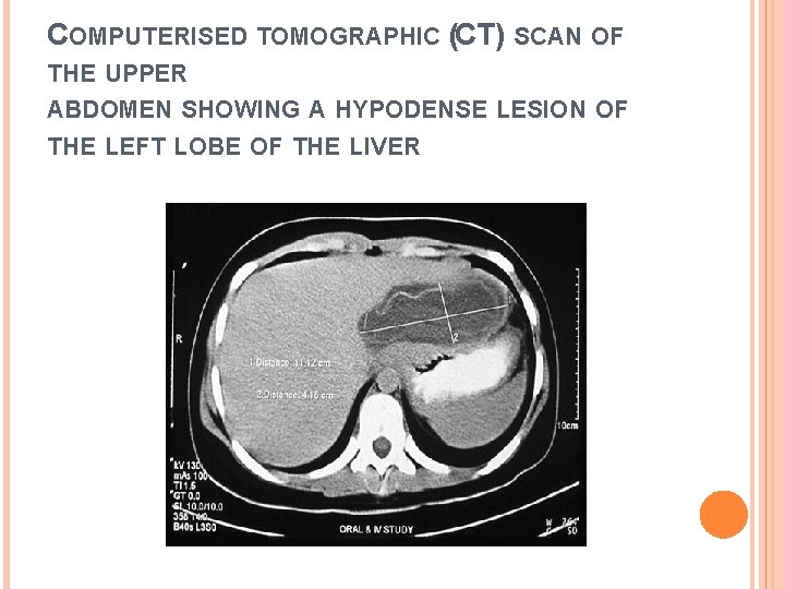 COMPUTERISED TOMOGRAPHIC (CT) SCAN OF THE UPPER ABDOMEN SHOWING A HYPODENSE LESION OF THE