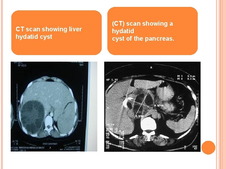 CT scan showing liver hydatid cyst (CT) scan showing a hydatid cyst of the