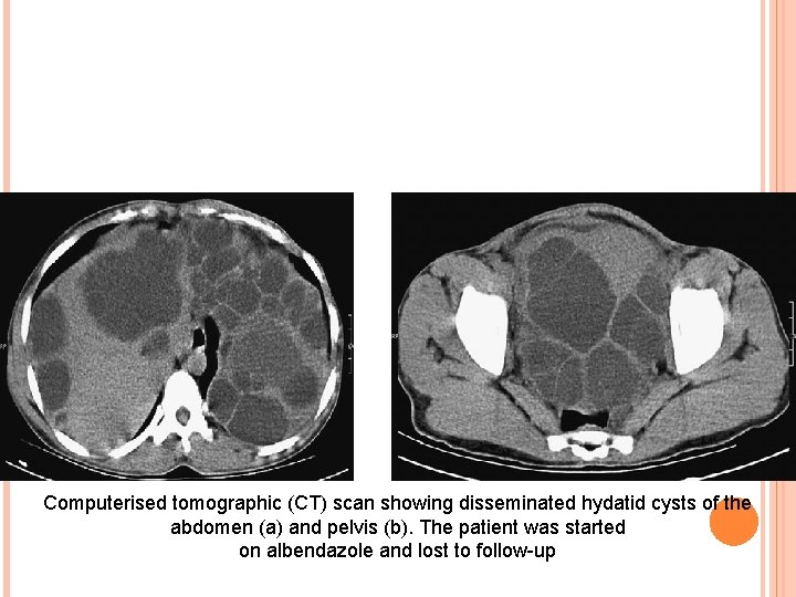 Computerised tomographic (CT) scan showing disseminated hydatid cysts of the abdomen (a) and pelvis