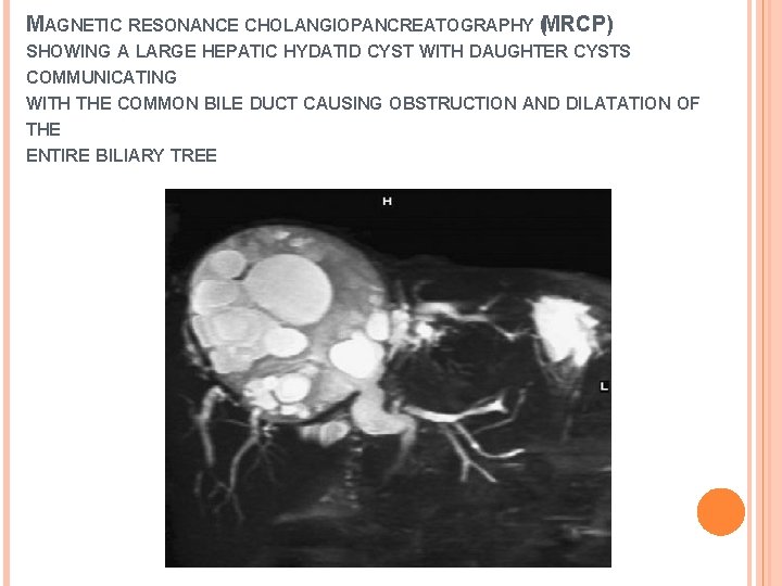 MAGNETIC RESONANCE CHOLANGIOPANCREATOGRAPHY (MRCP) SHOWING A LARGE HEPATIC HYDATID CYST WITH DAUGHTER CYSTS COMMUNICATING