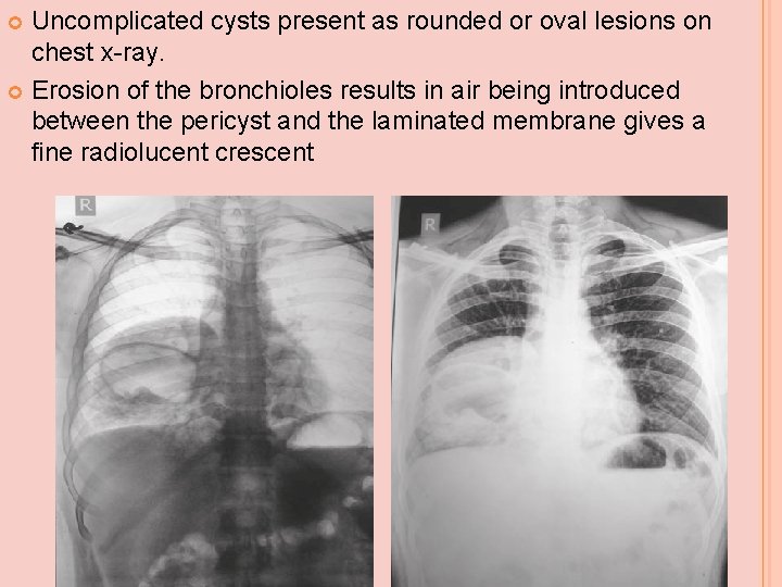 Uncomplicated cysts present as rounded or oval lesions on chest x-ray. Erosion of the