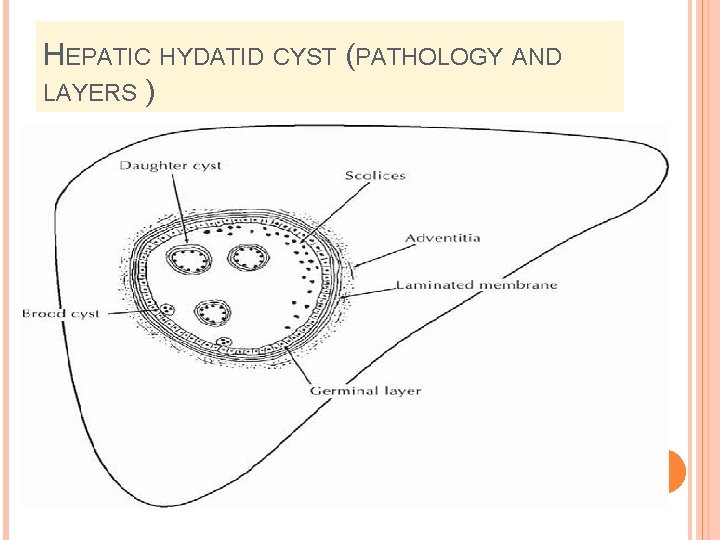 HEPATIC HYDATID CYST (PATHOLOGY AND LAYERS ) 