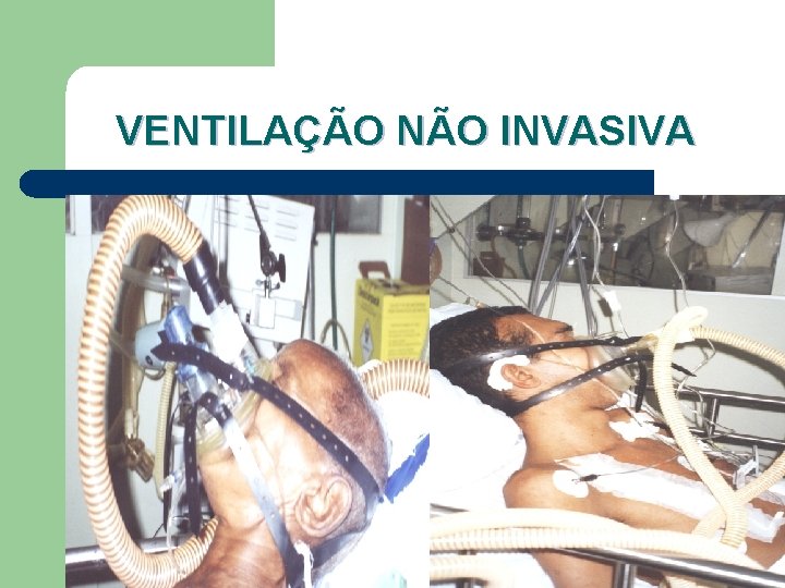 VENTILAÇÃO NÃO INVASIVA 