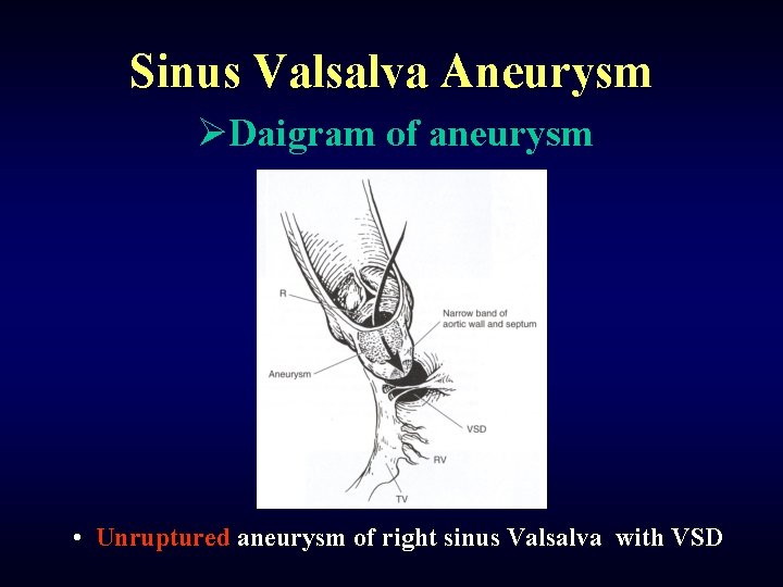 Sinus Valsalva Aneurysm ØDaigram of aneurysm • Unruptured aneurysm of right sinus Valsalva with