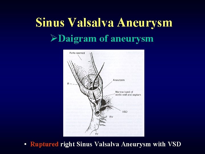 Sinus Valsalva Aneurysm ØDaigram of aneurysm • Ruptured right Sinus Valsalva Aneurysm with VSD