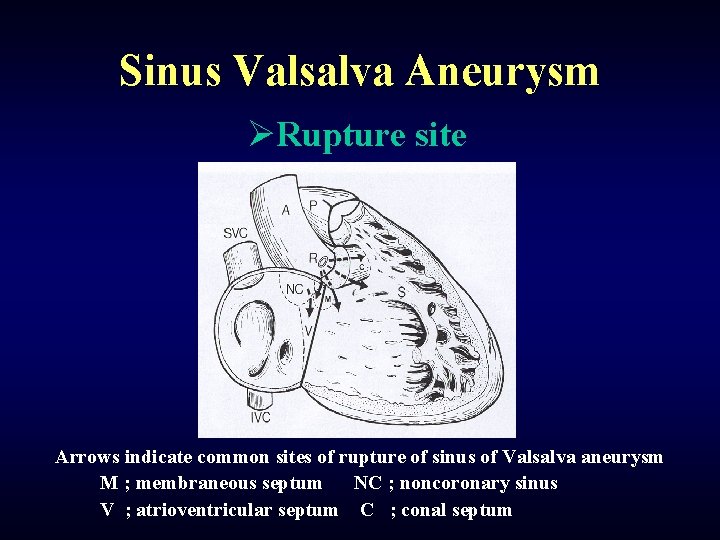 Sinus Valsalva Aneurysm ØRupture site Arrows indicate common sites of rupture of sinus of