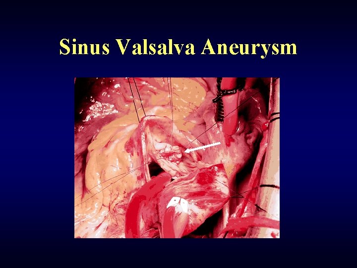 Sinus Valsalva Aneurysm 