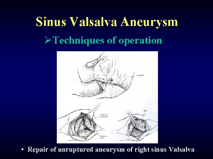 Sinus Valsalva Aneurysm ØTechniques of operation • Repair of unruptured aneurysm of right sinus