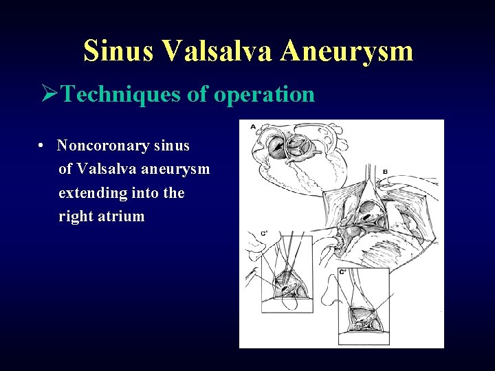 Sinus Valsalva Aneurysm ØTechniques of operation • Noncoronary sinus of Valsalva aneurysm extending into
