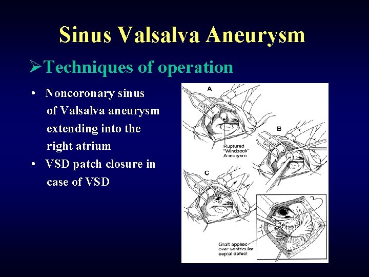 Sinus Valsalva Aneurysm ØTechniques of operation • Noncoronary sinus of Valsalva aneurysm extending into