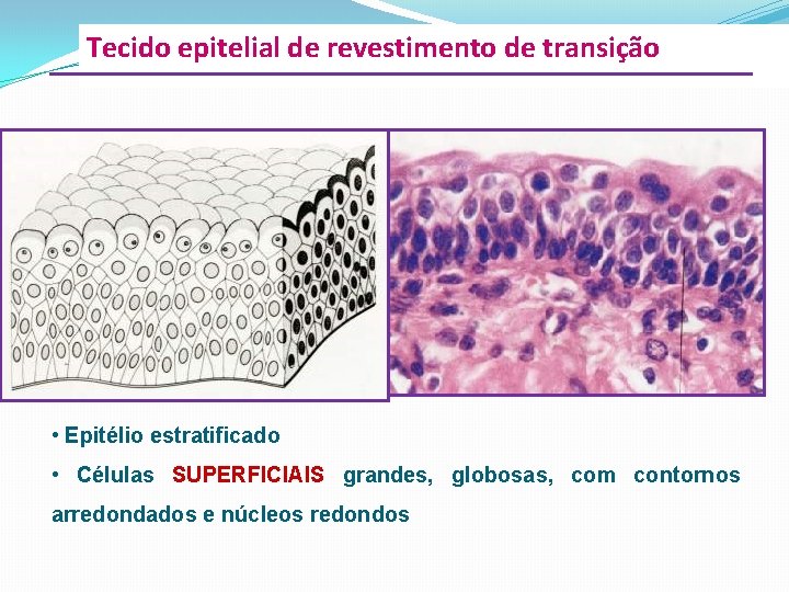 Tecido epitelial de revestimento de transição • Epitélio estratificado • Células SUPERFICIAIS grandes, globosas,