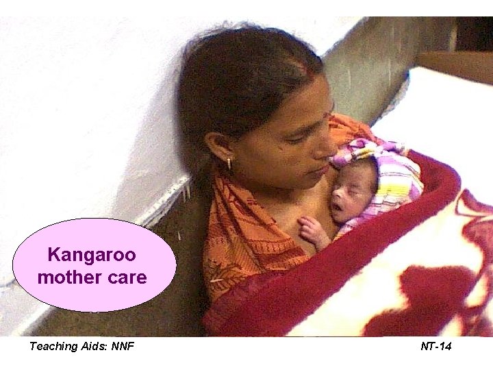 Kangaroo mother care Teaching Aids: NNF NT- 14 