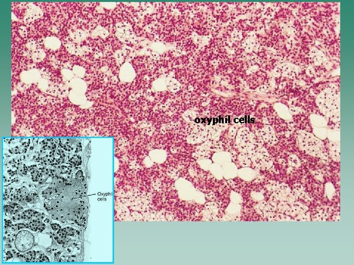 oxyphil cells 