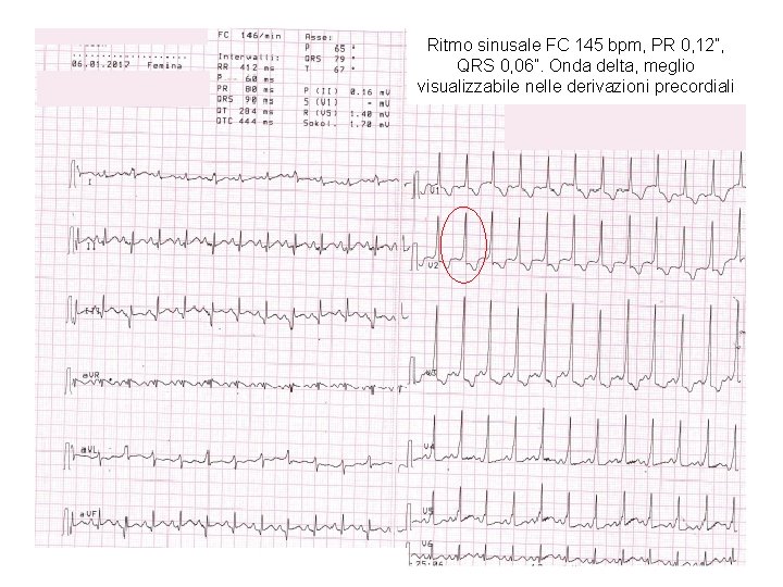 Ritmo sinusale FC 145 bpm, PR 0, 12”, QRS 0, 06”. Onda delta, meglio