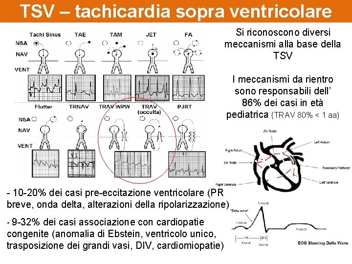 TSV – tachicardia sopra ventricolare Si riconoscono diversi meccanismi alla base della TSV I