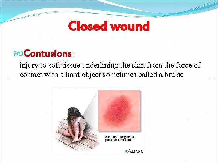 Closed wound Contusions : injury to soft tissue underlining the skin from the force